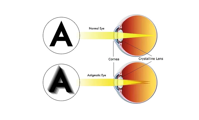 Astigmatism Correction